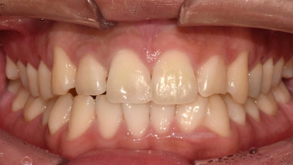 치료 후 이미지