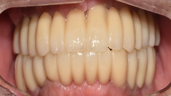 치료 후 이미지